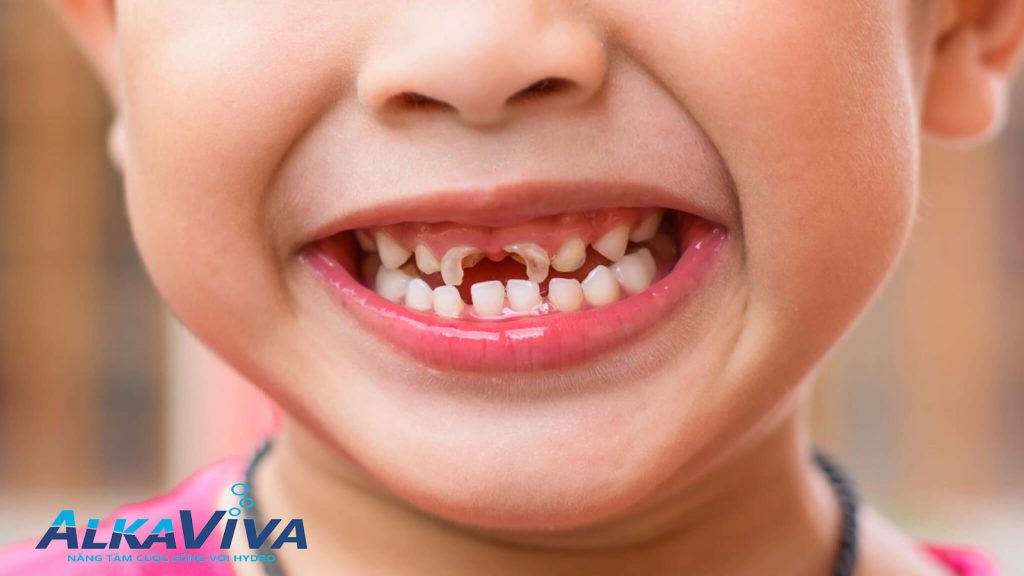 PHÒNG NGỪA BỆNH SÂU RĂNG HIỆU QUẢ NHỜ NƯỚC ĐIỆN GIẢI ION KIỀM
