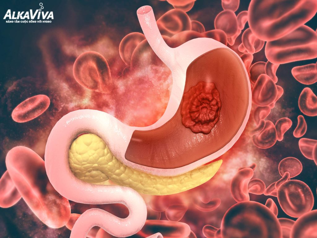 NƯỚC ION KIỀM CÓ GIÚP HỖ TRỢ ĐIỀU TRỊ UNG THƯ DẠ DÀY?