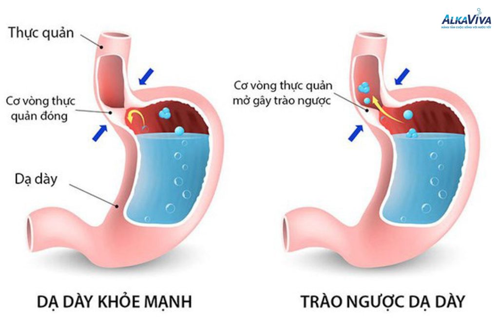 Bệnh dạ dày: Dấu hiệu, nguyên nhân và cách cải thiện trào ngược dạ dày hiệu quả